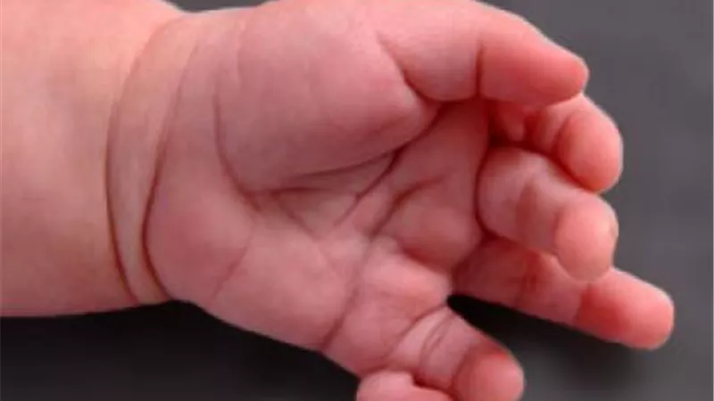 ما حكم بتر الأصبع الزائد لطفل حديث الولادة؟