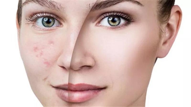 أبرزها موانع الحمل.. أدوية تقضي على حب الشباب نهائيًا