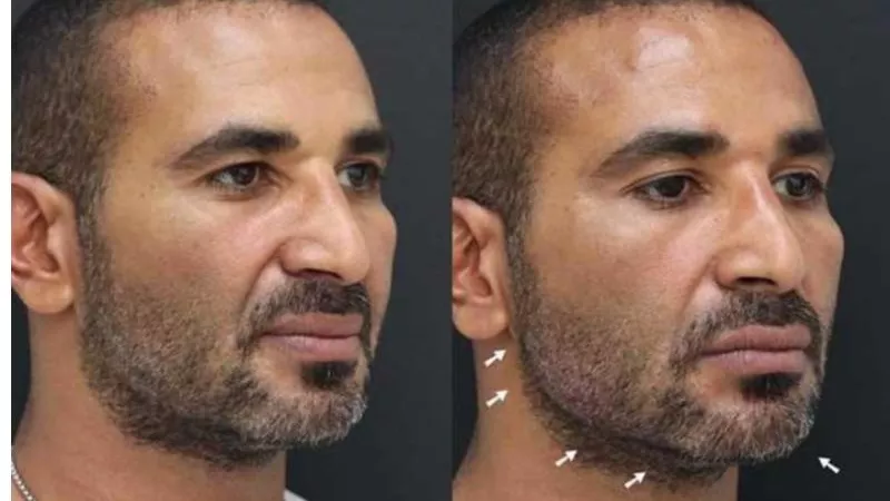 احمد سعد يجري عملية تجميل جديدة.. إليك التفاصيل