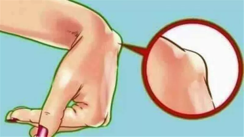 علاج الكيس الدهني في المعصم أو الرقبة
