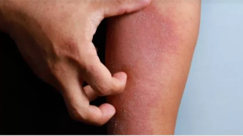 روشتة علاجية سريعة لمحاربة الحساسية في لمح البصر.. فما هي؟