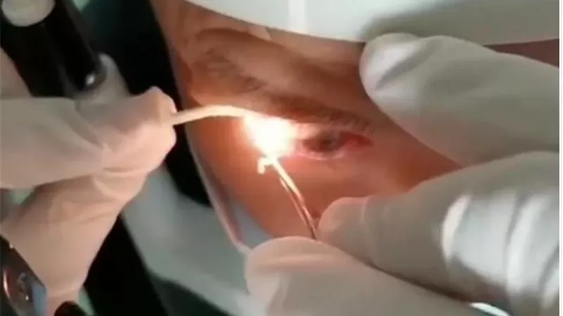 حالة غريبة من نوعها.. تفاصيل استخراج 20 دودة حية من عين رجل عاشت بداخله لمدة عام