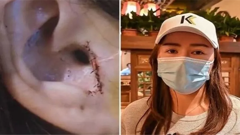 ذهبت لإجراء عملية تجميل لأنفها فقطع الأطباء جزء من أذنها