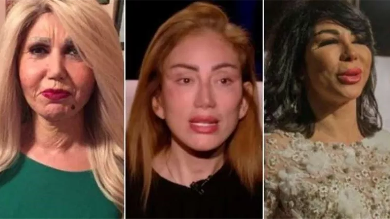 «جه يكحلها قتلها».. حكايات المشاهير مع عمليات التجميل الفاشلة