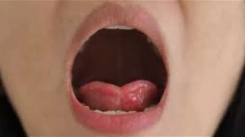 بلع اللسان.. هل هو أمر خطير وماذا تفعل عند حدوثه ؟