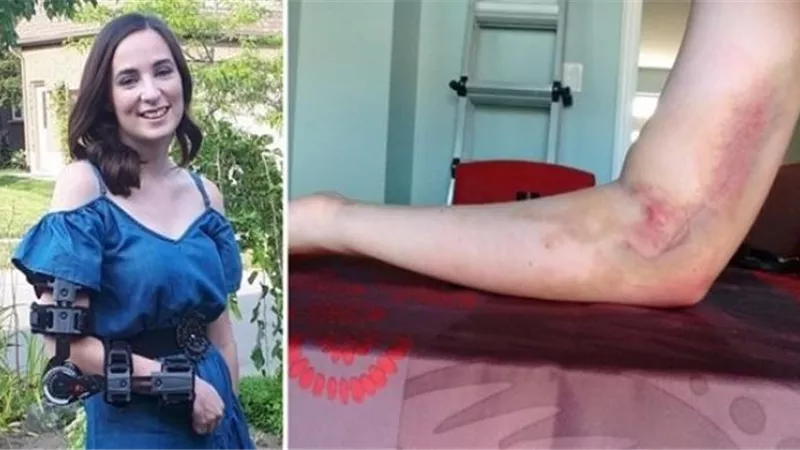 فتاة تبرعت بالدم فأصيبت بالشلل.. السبب خطأ ممرضة