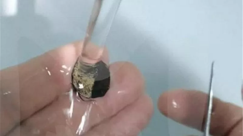 ظلت 50 عاماً داخل أنفه.. جراحة عاجلة لاستخراج عملة معدنية من وجه رجل روسي