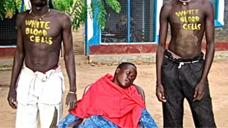 حقيقة إصابة 46 ألف سوداني بمرض الإيذر