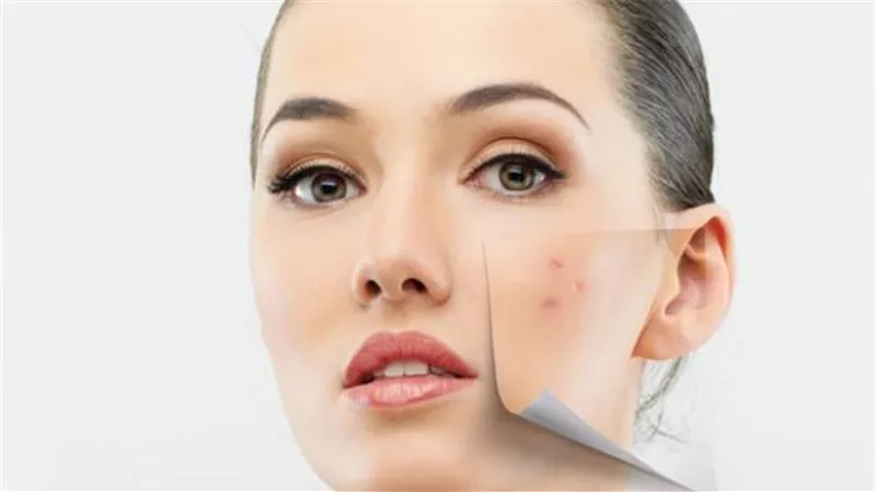 حيل سحرية مذهلة لإخفاء بثور الوجه بالمكياج