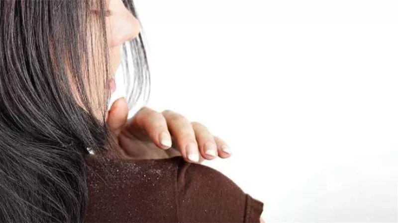 5 مكونات طبيعية فعالة للقضاء على قشر الشعر في الصيف