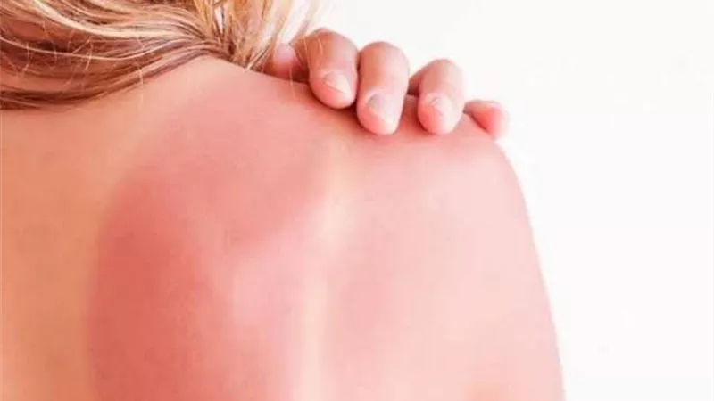 نصائح سحرية للحماية من حروق الشمس.. تعرفي عليها