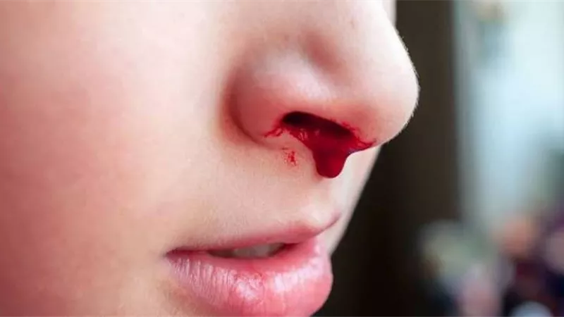 ما هو الرعاف؟ ولماذا يصيب بعض الأشخاص؟