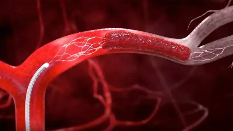 في يومها العالمي.. أعراض ومخاطر الأنيميا المنجلية وطرق علاجها