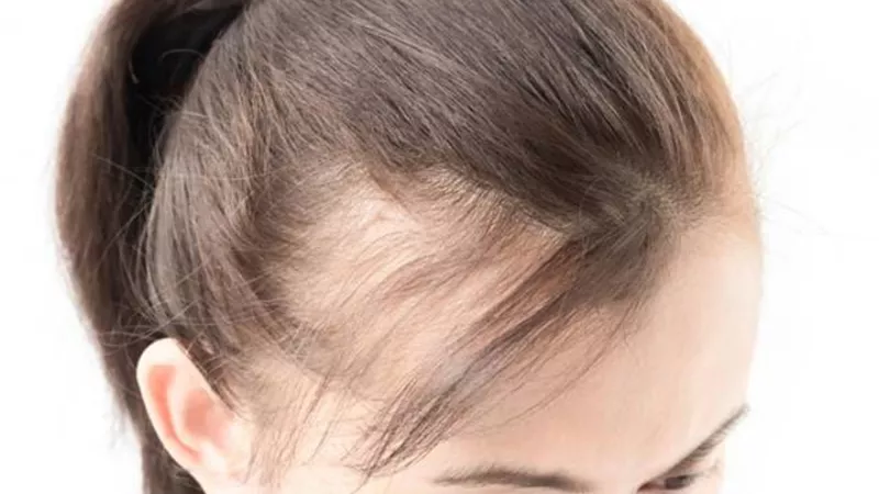 اكتشاف مستخلص نباتي لعلاج الصلع