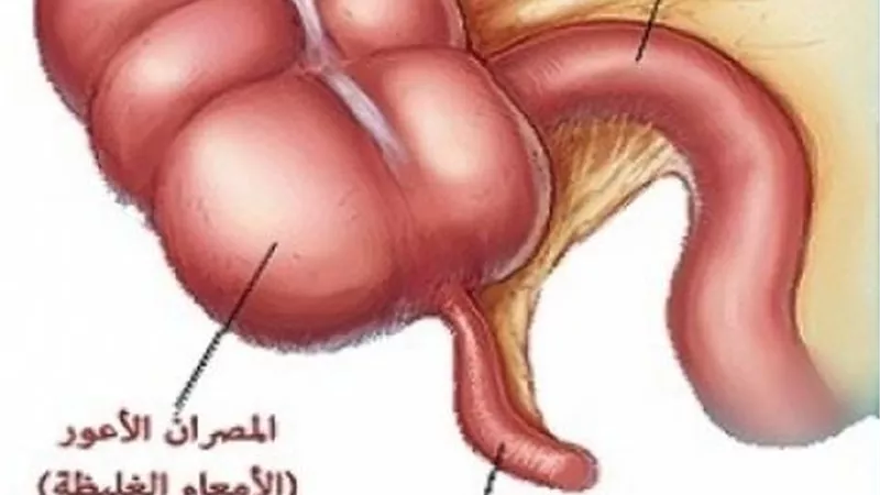 أسباب التهاب الزائدة الدودية لدى الأطفال