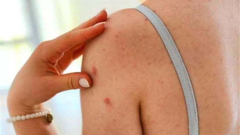للسيطرة عليه منذ  البداية..6 أعراض للحزام الناري