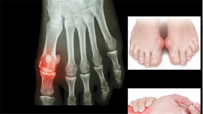 روشتة سحرية لعلاج النقرس في المنزل