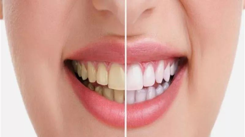 تخلصي من إصفرار الأسنان.. بهذه الطريقة السحرية
