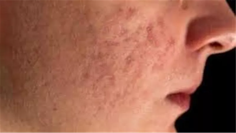 عادات يومية تقتل نضارة البشرة في الصيف.. عدم  تنظيف غطاء وسادة 