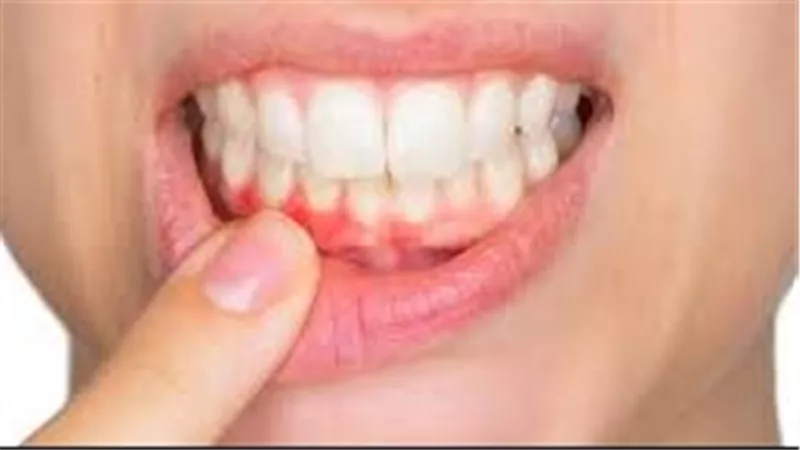 ماهي أسباب التهابات اللثة؟.. وطرق الوقاية منها في منزلك
