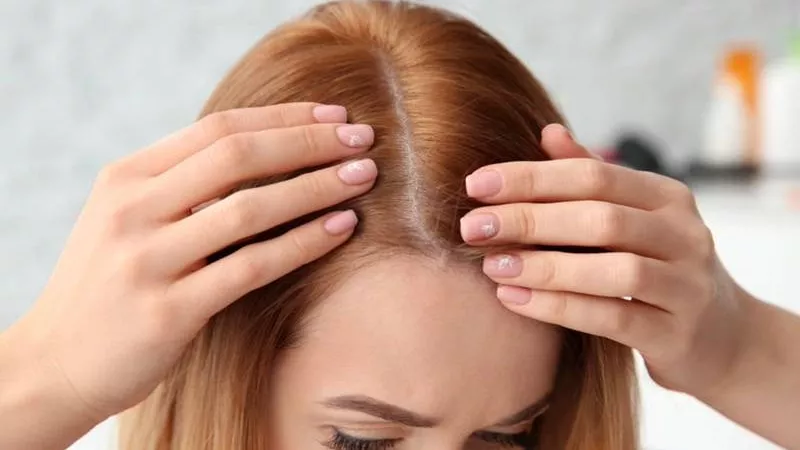 تتكون بسبب التعرق.. مكونات منزلية للتخلص من قشر الشعر العنيدة