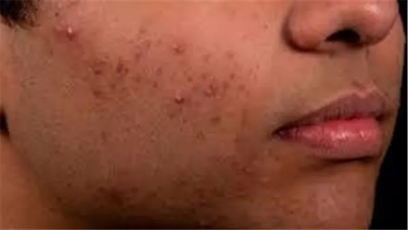 وضع واقي الشمس وشرب المياة.. طرق فعالة في علاج حب الشباب