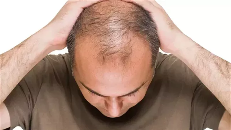 تجنب تلك العادات السيئة .. أسباب تساقط الشعر المفاجئ