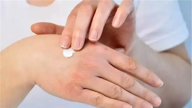 جفاف اليدين في الشتاء؟ إليك الحلول الفعّالة لحمايتها