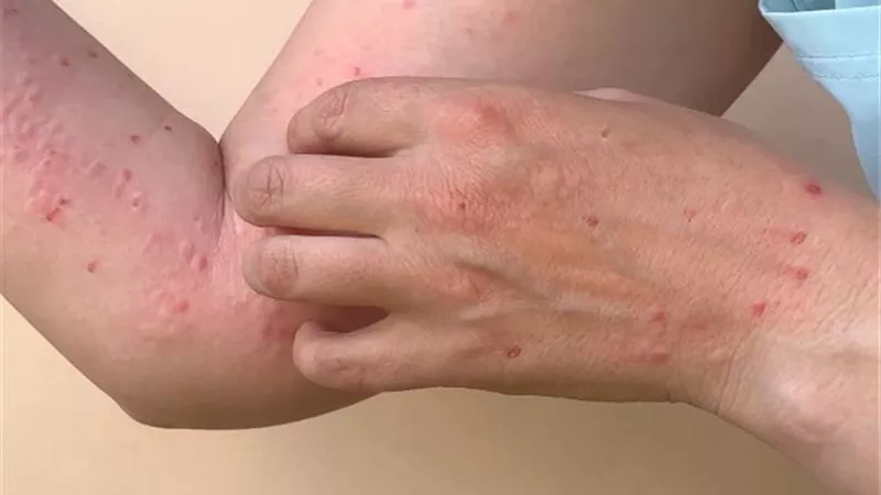 فيروس جدري القرود..هل تشكل سلالة 1ب خطرًا عالميًا؟