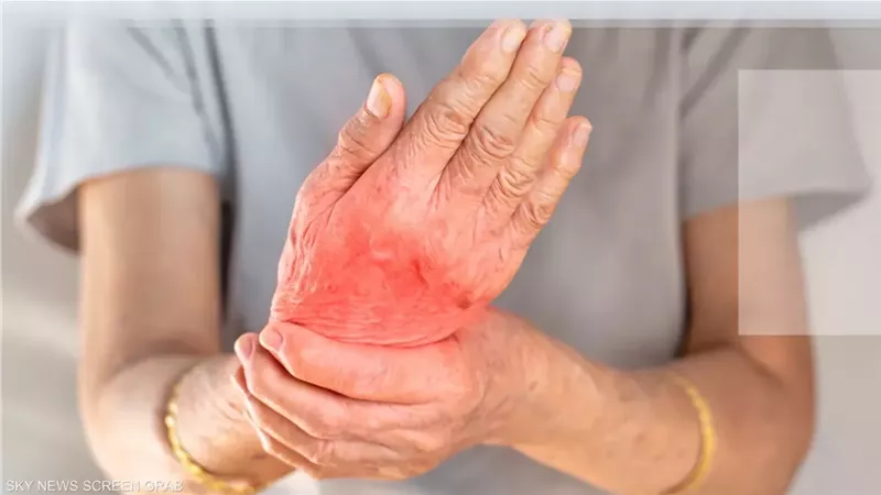 أسباب التهاب المفاصل الروماتويدي والأعراض وطرق العلاج .. تعرف على التفاصيل 