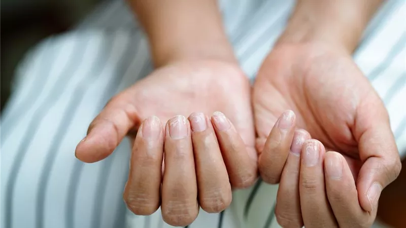 مشاكل الأظافر الأكثر شيوعًا .. من الهشاشة إلى الخطوط السوداء