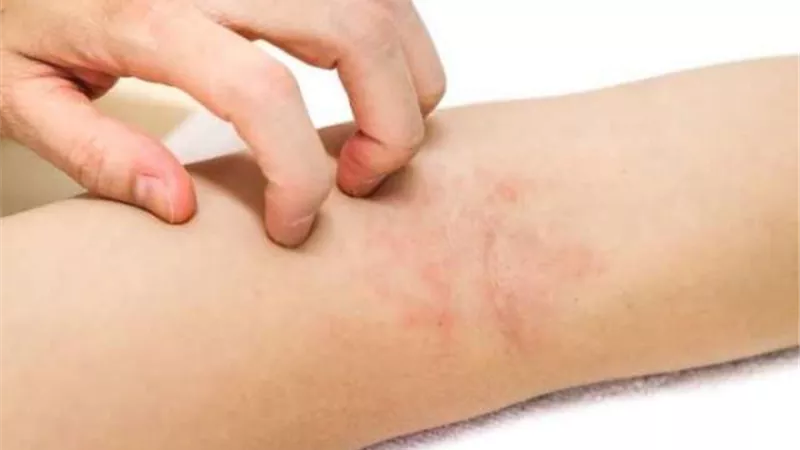حيل سحرية لعلاج حساسية الجلد.. تعرفي عليها