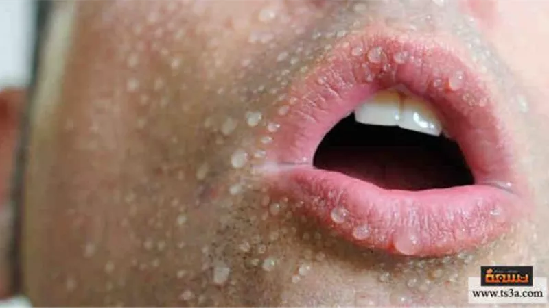 انتبه... هذه علامات تناول جرعة زائدة من الباراسيتامول
