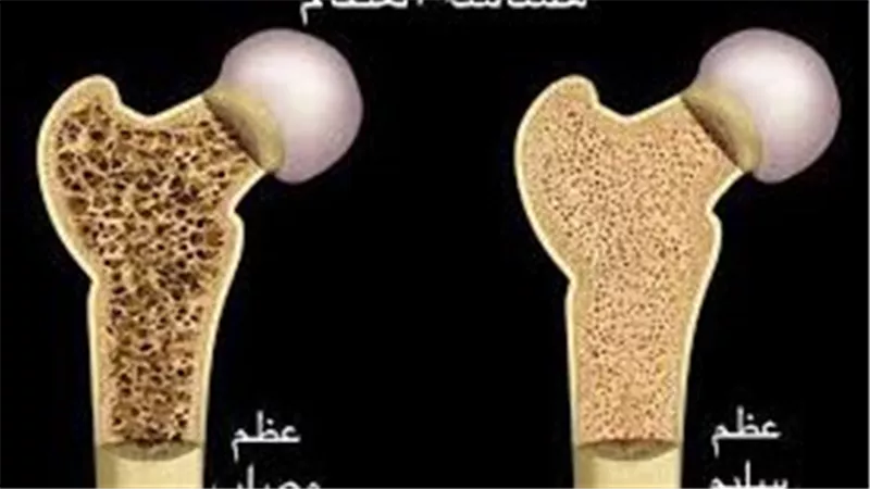 علاج هشاشة العظام.. هيئة الدواء المصرية توصي بالكالسيوم والرياضة والأدوية المناسبة
