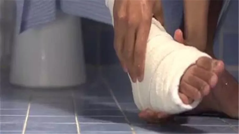 المسح على الجبيرة أثناء الوضوء.. حكمه الشرعي وكيفية تطبيقه بالشكل الصحيح
