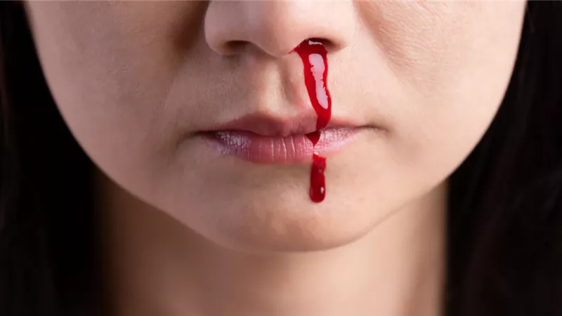 نزيف الأنف المفاجئ.. كيفية التعامل مع الحالة وعلاجها سريعًا