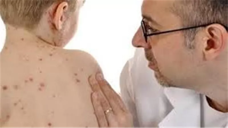 تسجيل أول وفاة بالحصبة في أمريكا منذ 2015 وتحذيرات من تفشي المرض