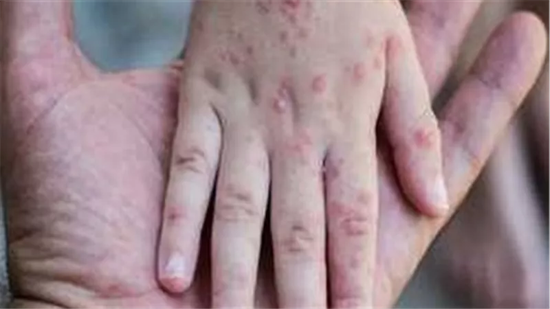 استشاري مناعة يوضح الفرق بين الجدري والجدري المائي وخطورة الإصابة عند الكبار