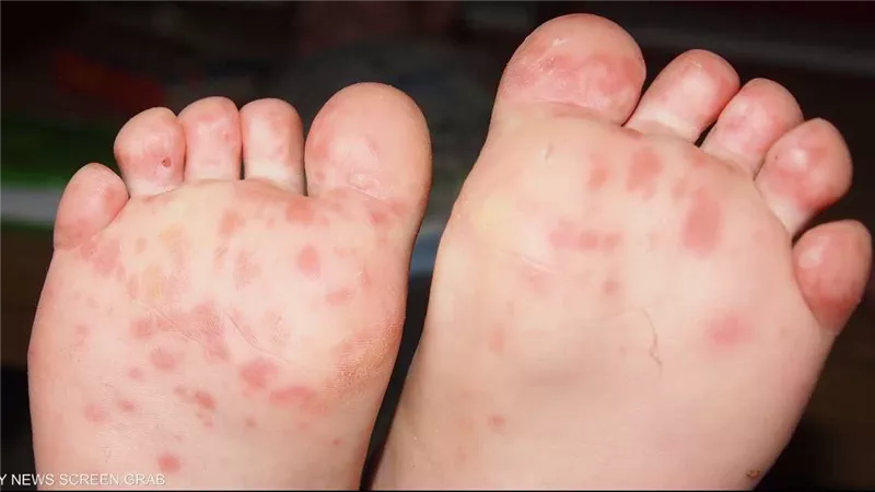 بعد ظهوره بين طلاب الجيزة.. كل ما تريد معرفته عن فيروس اليد والقدم والفم