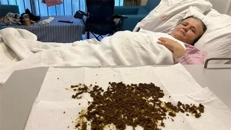 استخراج عشرين ألف حصوة من مريضة تركية في حالة طبية نادرة مذهلة