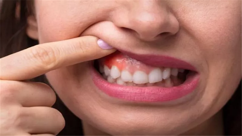 ماذا تعرفين عن التهاب اللثة أثناء الحمل؟.. إليك الإجابة